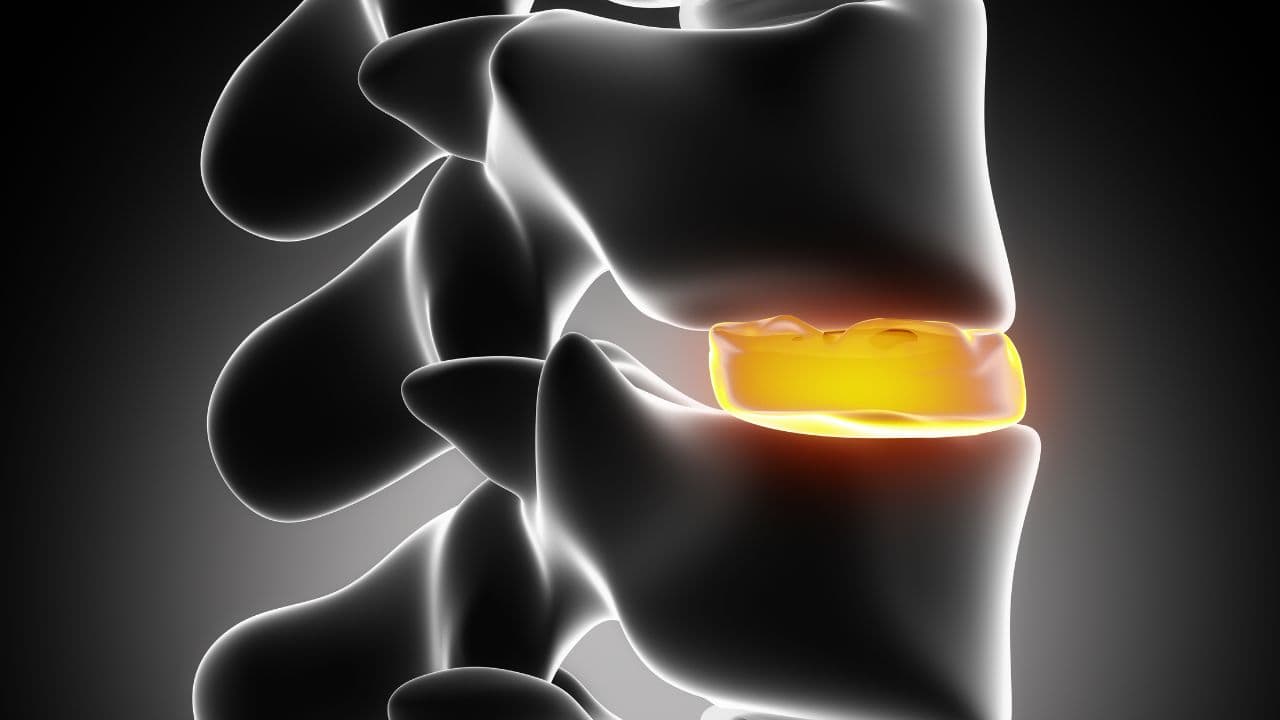 Osteófitos Marginais: como comprovar incapacidade para o INSS?