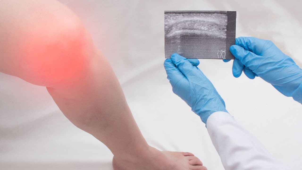 Gonartrose CID: saiba o que é e se dá direito à aposentadoria