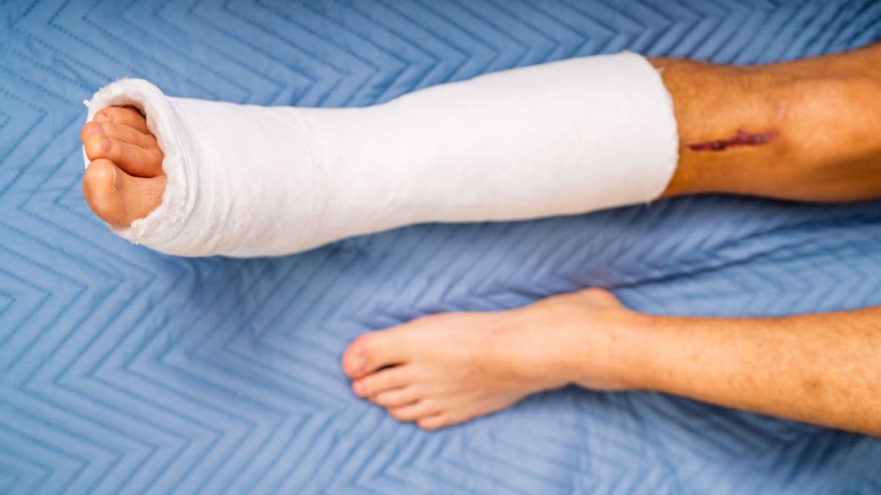 Sequelas de fratura de tíbia e fíbula: direitos e indenização