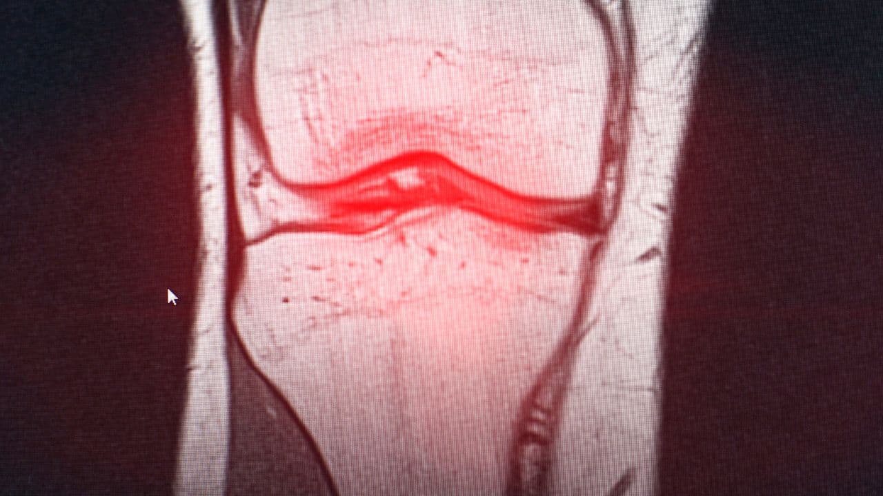 Artrose isenção imposto de renda: quem tem direito legal