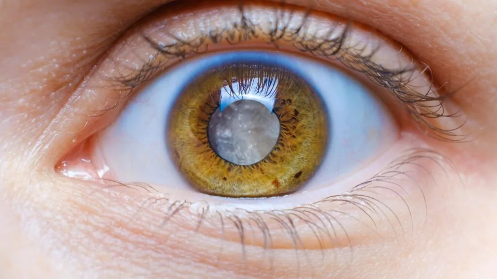 Quem tem glaucoma pode se aposentar