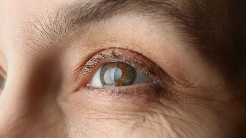 Quem tem glaucoma pode se aposentar