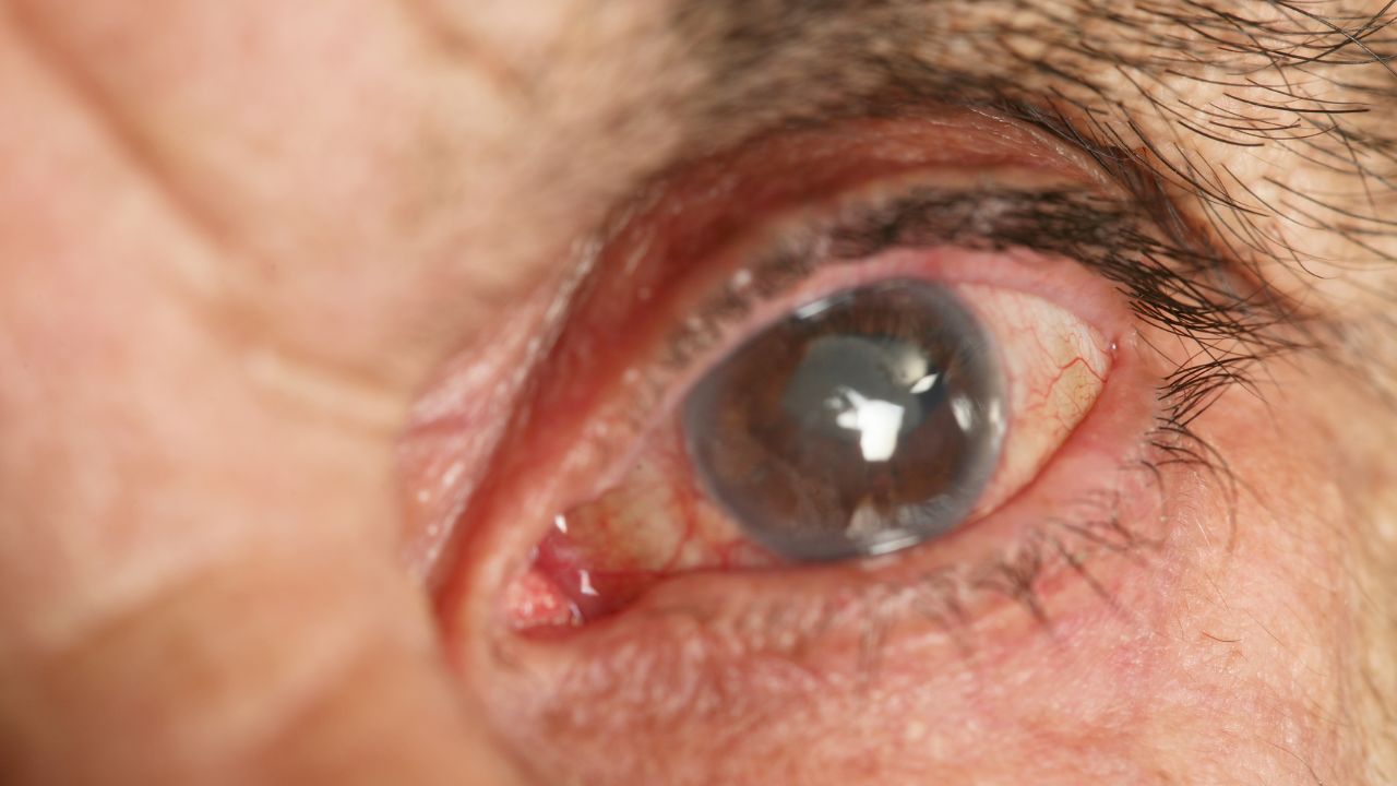 Quem tem glaucoma pode se aposentar