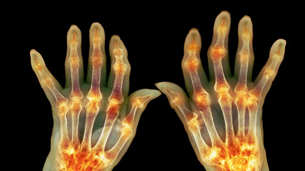 artrite reumatoide aposentadoria auxilio