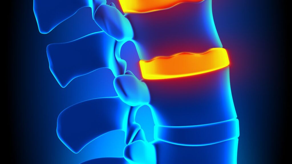 Osteófitos marginais