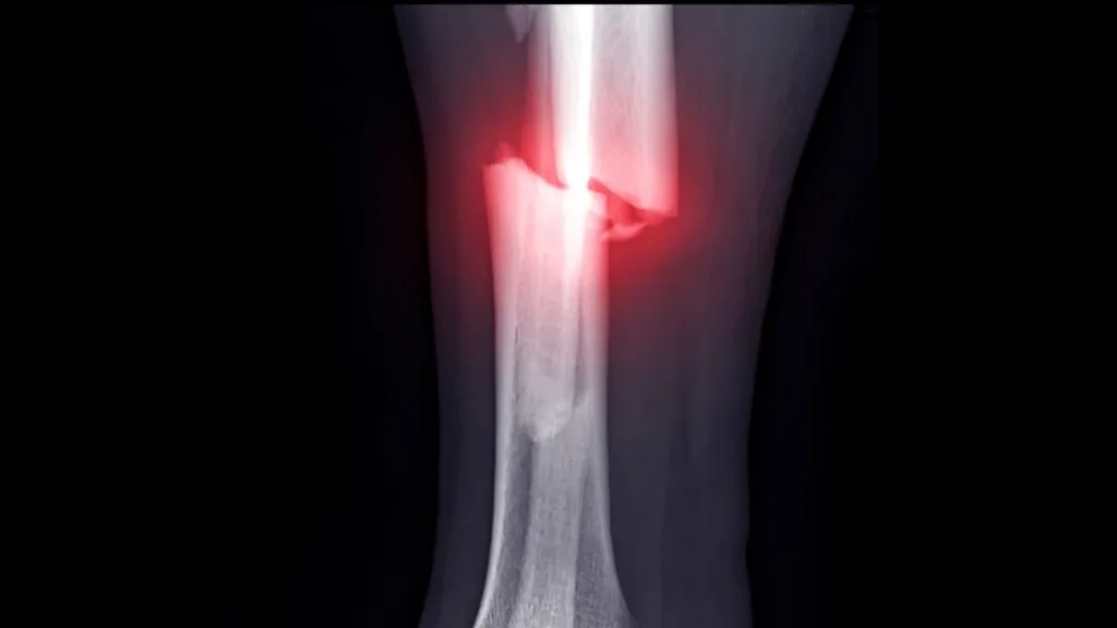 Sequelas de fratura de tíbia e fíbula