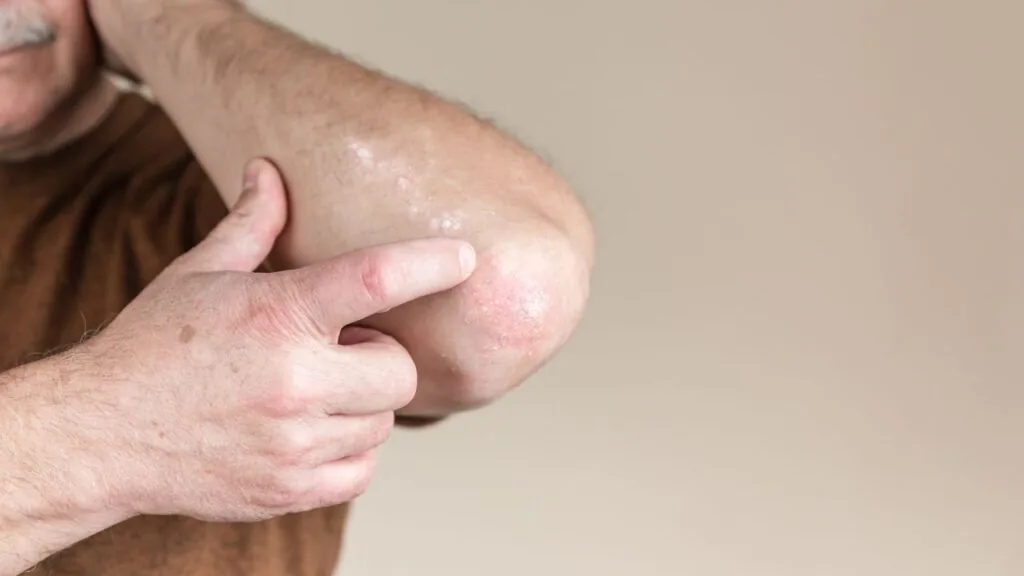 epicondilite lateral do cotovelo aposenta