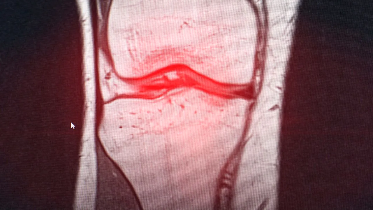 Artrose isenção imposto de renda: quem tem direito legal