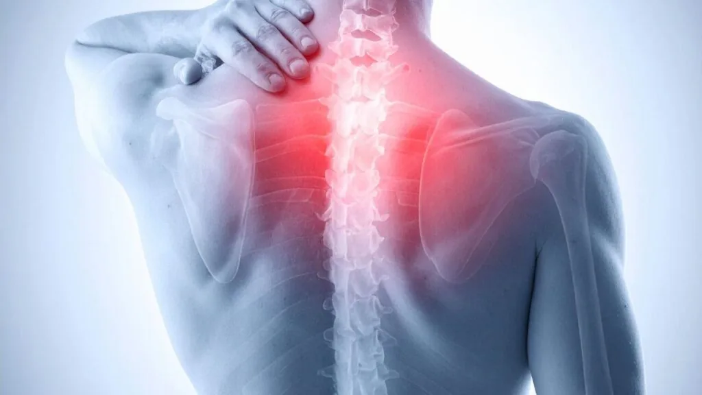 CID Cervicobraquialgia