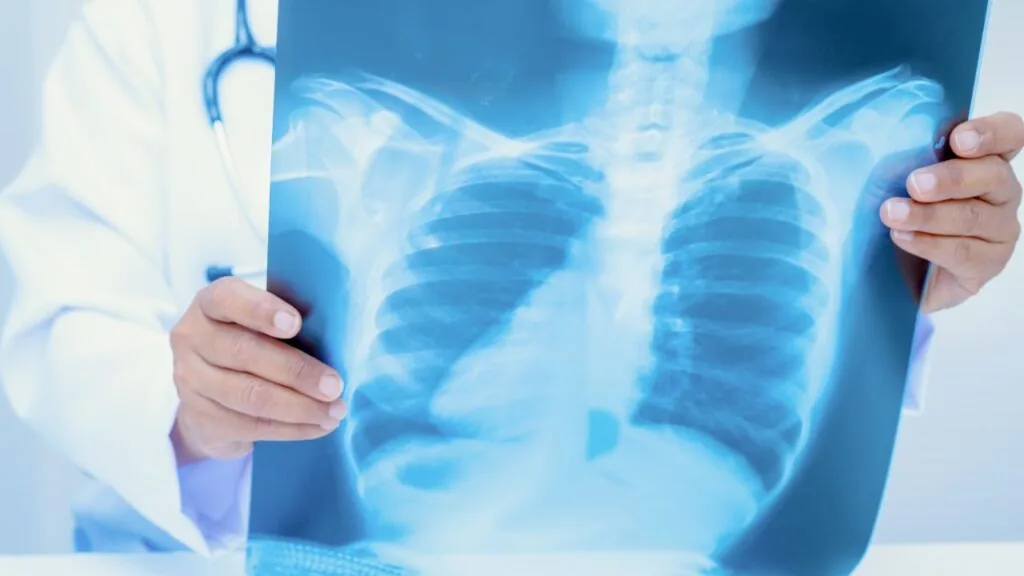 Quais doenças têm direito ao LOAS